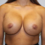 Breast Augmentation Before & After Patient #3225