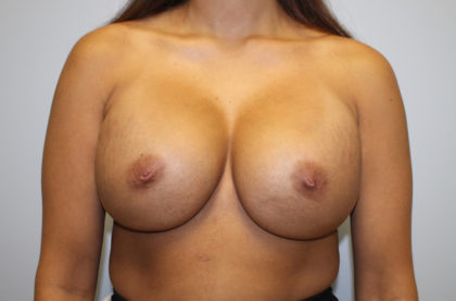 Breast Augmentation Before & After Patient #3225