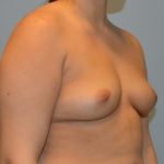 Breast Augmentation Before & After Patient #3225