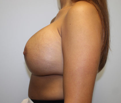 Breast Augmentation Before & After Patient #3225