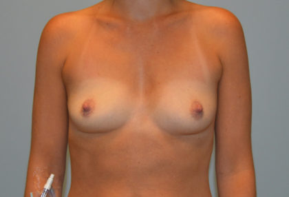 Breast Augmentation Before & After Patient #3236