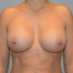 Breast Augmentation Before & After Patient #3236