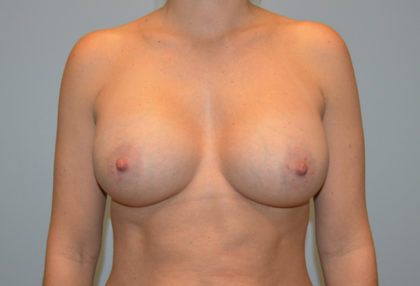 Breast Augmentation Before & After Patient #3236