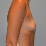 Breast Augmentation Before & After Patient #3236