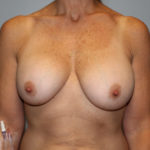 Corrective Breast Procedures Before & After Patient #3247