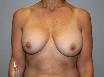 Corrective Breast Procedures Before & After Patient #3247