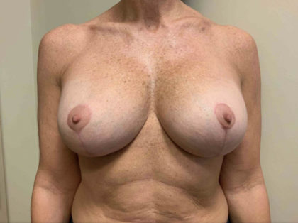 Corrective Breast Procedures Before & After Patient #3247