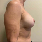 Corrective Breast Procedures Before & After Patient #3247