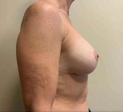 Corrective Breast Procedures Before & After Patient #3247