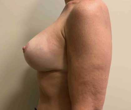 Corrective Breast Procedures Before & After Patient #3247