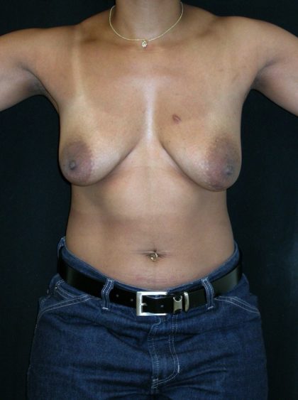 Breast Lift Before & After Patient #3384