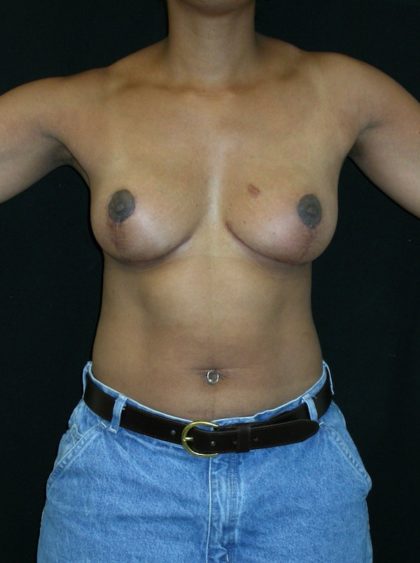 Breast Lift Before & After Patient #3384