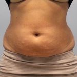 Fat Reduction (Non-Invasive) Before & After Patient #3356