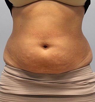 Fat Reduction (Non-Invasive) Before & After Patient #3356