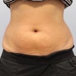 Fat Reduction (Non-Invasive) Before & After Patient #3356