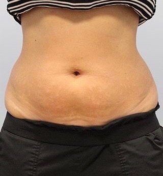 Fat Reduction (Non-Invasive) Before & After Patient #3356