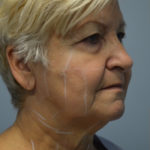 Ultherapy (Non-invasive Skin Tightening) Before & After Patient #3317