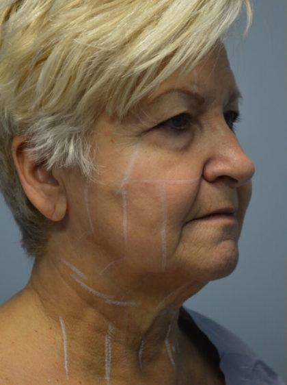 Ultherapy (Non-invasive Skin Tightening) Before & After Patient #3317