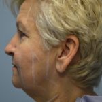 Ultherapy (Non-invasive Skin Tightening) Before & After Patient #3317