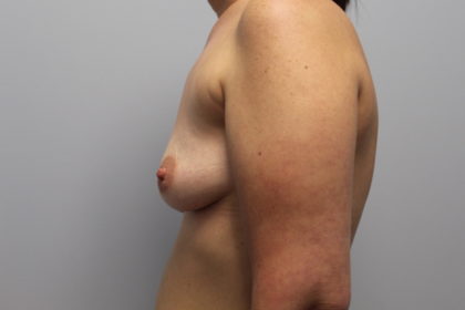 Corrective Breast Procedures Before & After Patient #3446