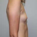 Breast Augmentation Before & After Patient #3436