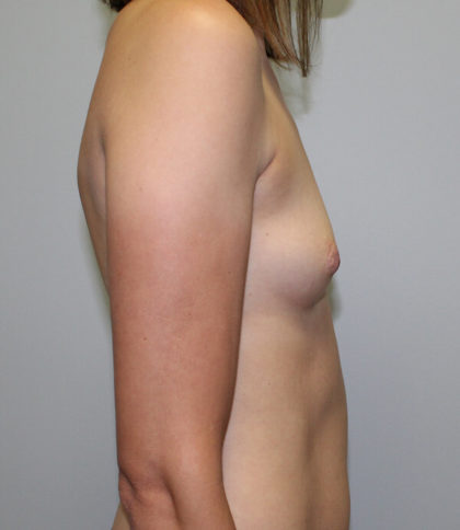 Breast Augmentation Before & After Patient #3436