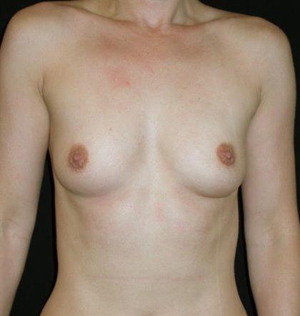 Breast Augmentation Before & After Patient #3470