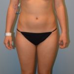 Liposuction Before & After Patient #3631