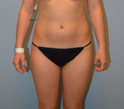 Liposuction Before & After Patient #3631