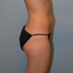 Liposuction Before & After Patient #3631