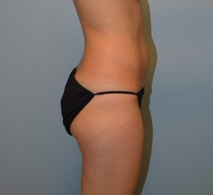 Liposuction Before & After Patient #3631