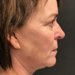 Neck Lift Before & After Patient #3832