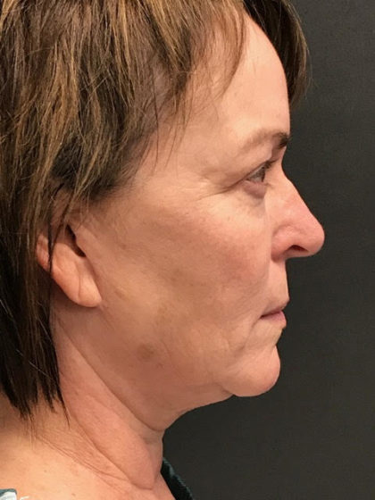 Neck Lift Before & After Patient #3832