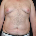 Liposuction Before & After Patient #3800