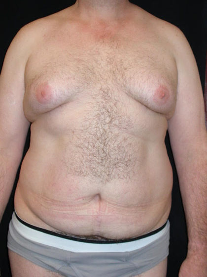 Liposuction Before & After Patient #3800