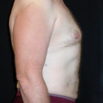 Liposuction Before & After Patient #3800