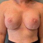 Breast Lift Before & After Patient #3765