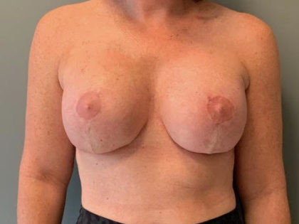 Breast Lift Before & After Patient #3765