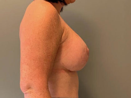 Breast Lift Before & After Patient #3765