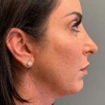 Neck Lift Before & After Patient #3753