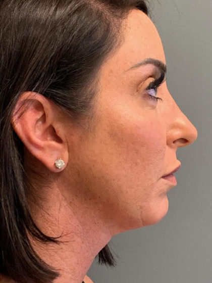 Neck Lift Before & After Patient #3753