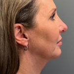 Deep Plane Neck Lift Before & After Patient #3746