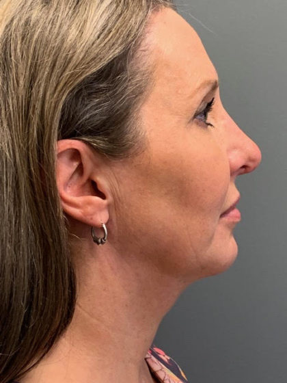 Deep Plane Neck Lift Before & After Patient #3746