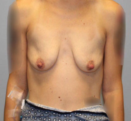 Breast Augmentation Before & After Patient #3671