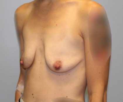 Breast Augmentation Before & After Patient #3671
