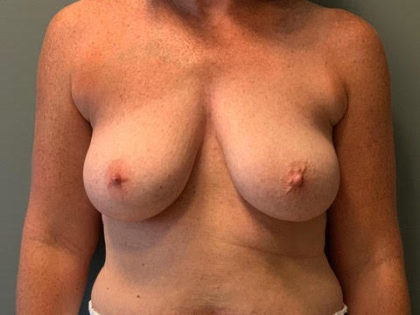 Breast Lift Before & After Patient #3765