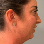 Neck Lift Before & After Patient #3753