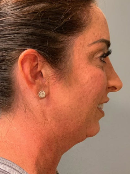 Neck Lift Before & After Patient #3753
