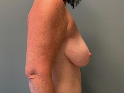 Breast Lift Before & After Patient #3765