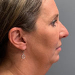 Deep Plane Neck Lift Before & After Patient #3746